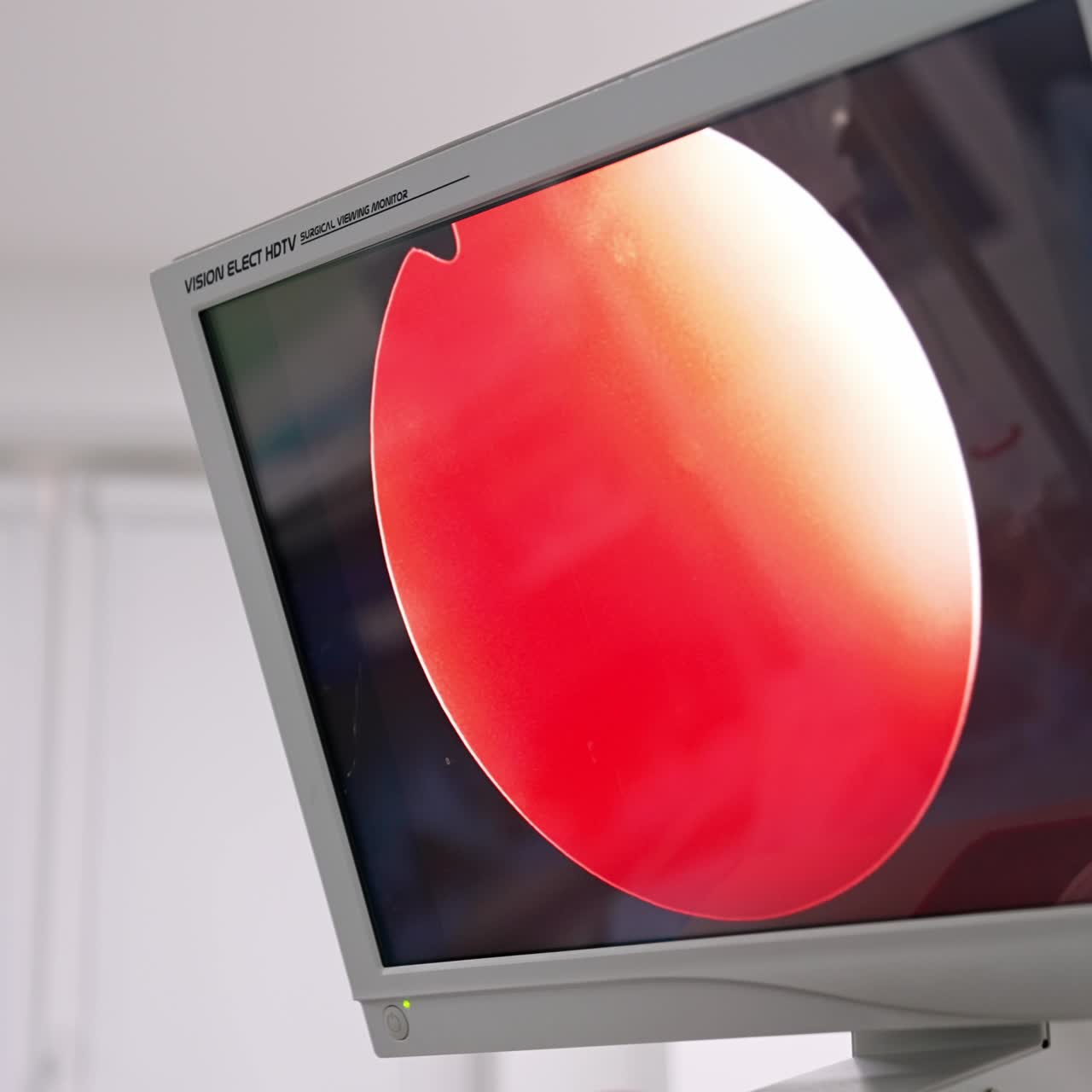 Monitor in surgery room showing the laparoscopic operation from inside. Modern equipment in operational theatre