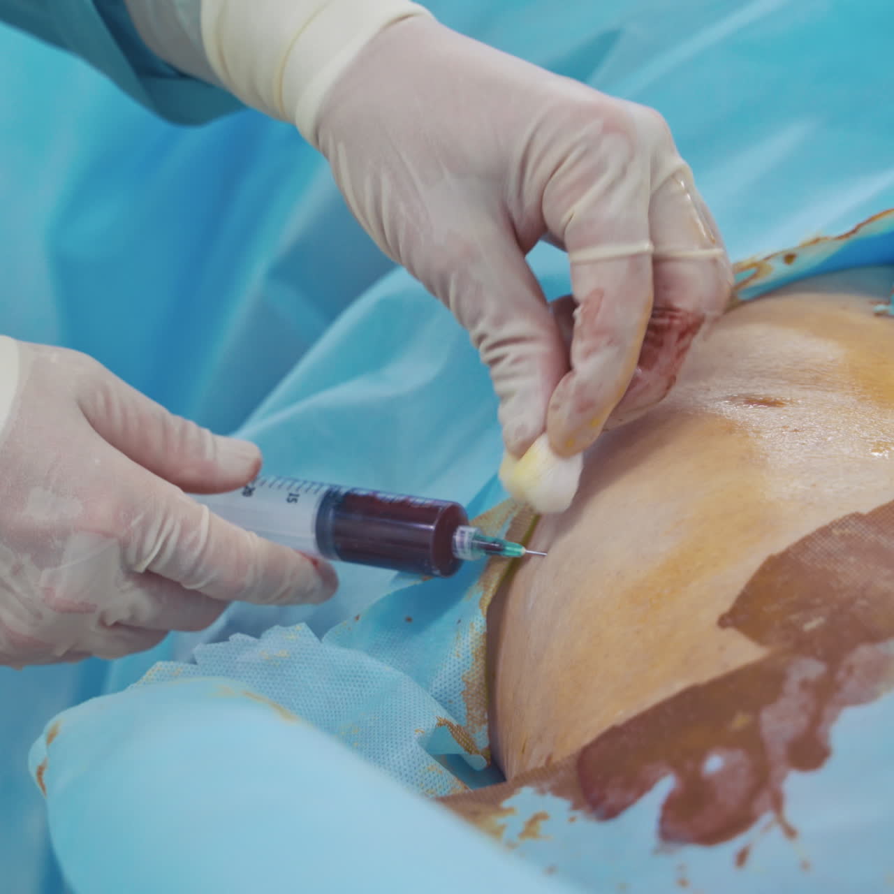 Stem cells injection. Doctor makes blood injection into the patient's body. Specialist's hands in gloves with syringe. Close-up.