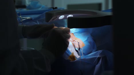 corrección de la visión con láser. un paciente y un equipo de cirujanos en la sala de operaciones durante una cirugía oftalmológica. especulo del párpado. tratamiento de lasik. paciente bajo una cubierta estéril