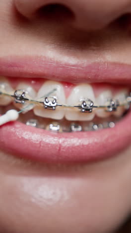 mujer con aparatos dentales limpiándose los dientes