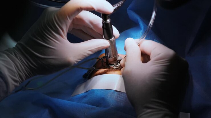 Correzione della vista con il laser. Un paziente e un team di chirurghi nella sala operatoria durante un intervento di chirurgia oftalmica. Divaricatore palpebrale. Trattamento Lasik. Paziente sotto copertura sterile