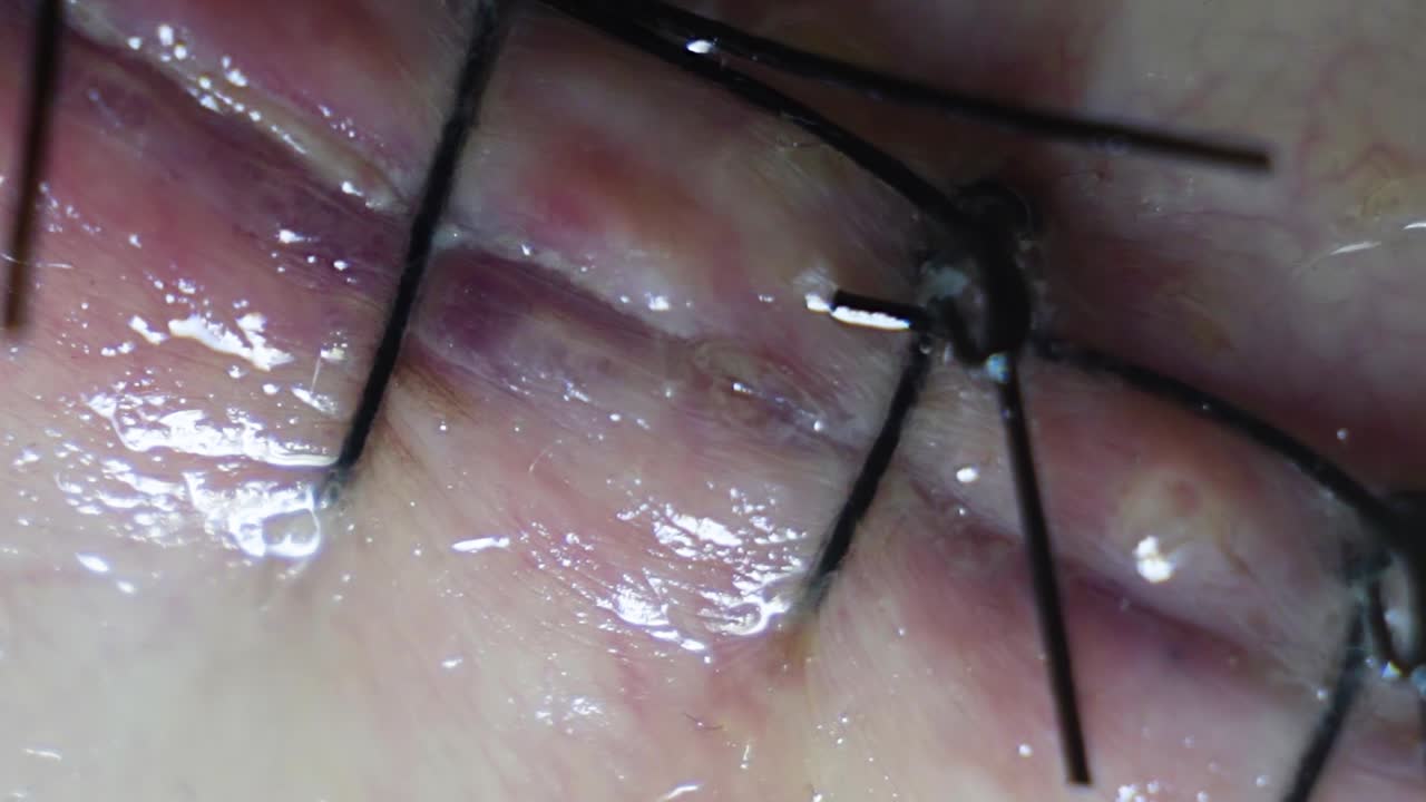 수술 후 백인 남성의 등에 있는 커다란 바늘로 꿰매는 극단적인 극단