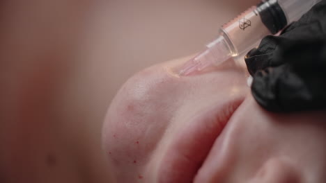 procedimiento de inyección facial