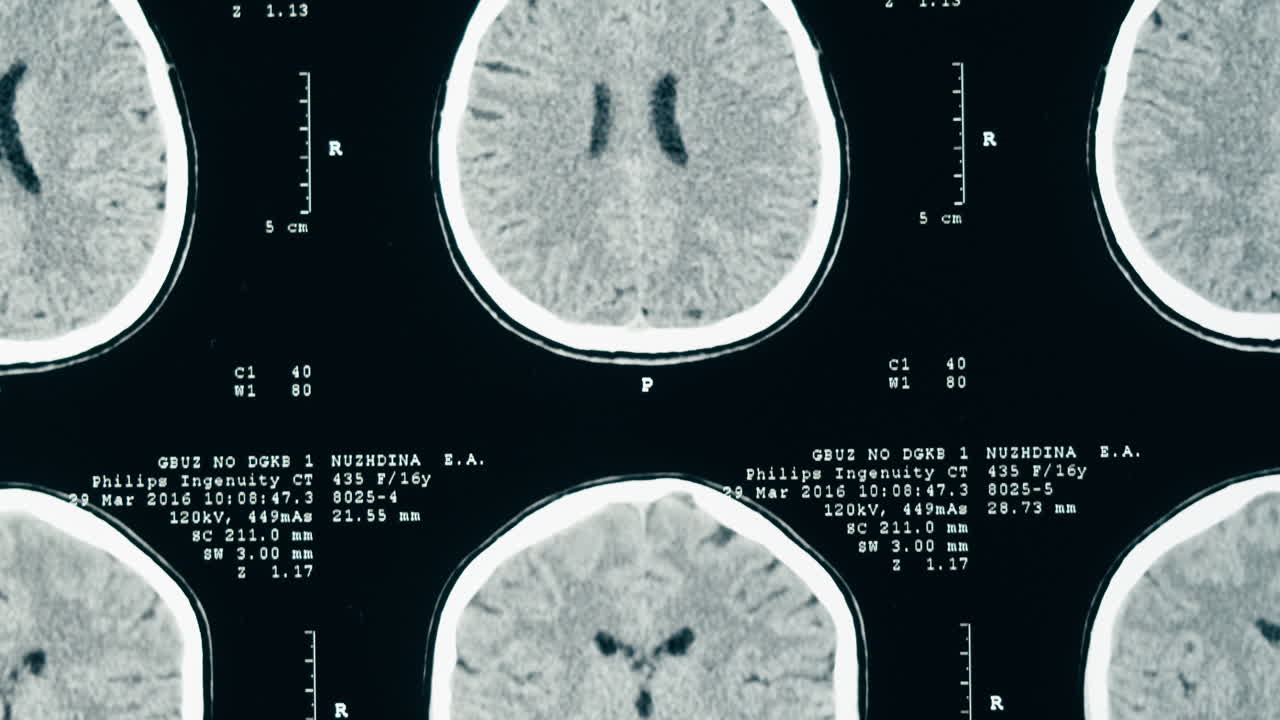Vista ravvicinata di una TAC del cervello umano per la diagnosi medica