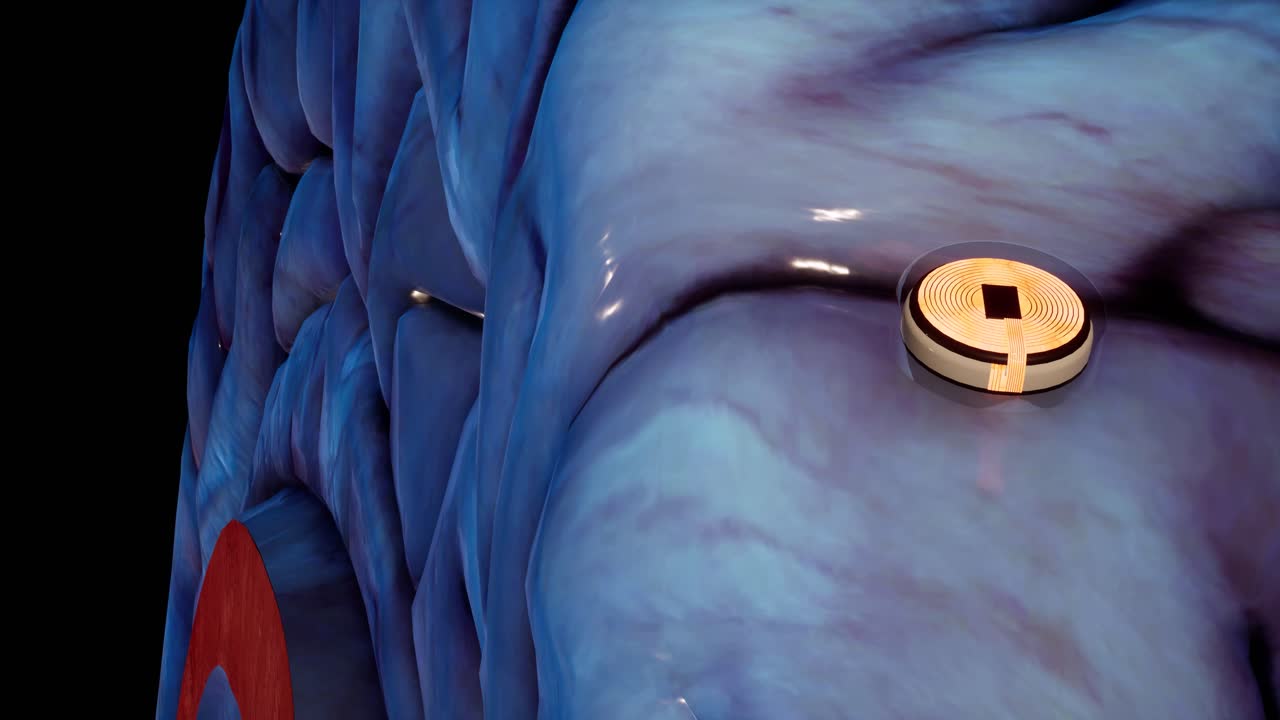 tecnología de implante de interfaz neuronal animada