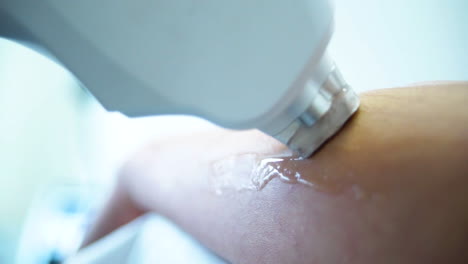 팔에 레이저 제거 절차
