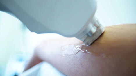 laser hair removal procedure on arm