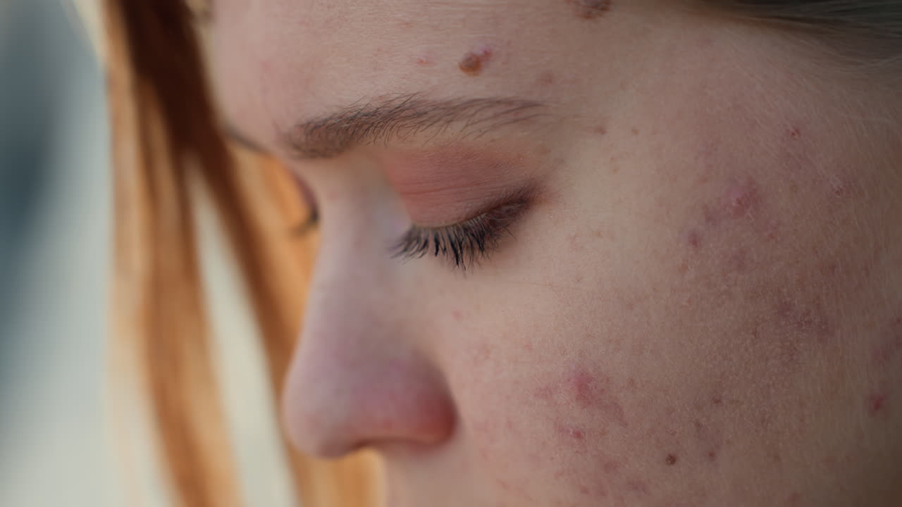 Primo piano di giovane donna bianca adolescente con acne, sguardo contemplativo, luce esterna soffusa, rossore visibile e guance con imperfezioni, trucco minimale, studentessa che riflette all'aperto, silenziosa vulnerabilità e speranza.