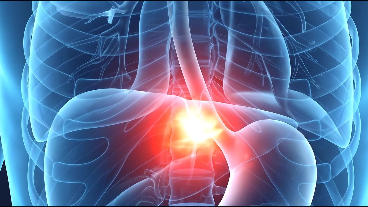 Animazione medica di reflusso acido e bruciore di stomaco nell'anatomia umana