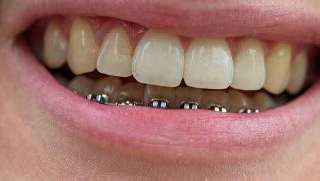 macro shot of mouth smiling with braces on bottom teeth in slow motion