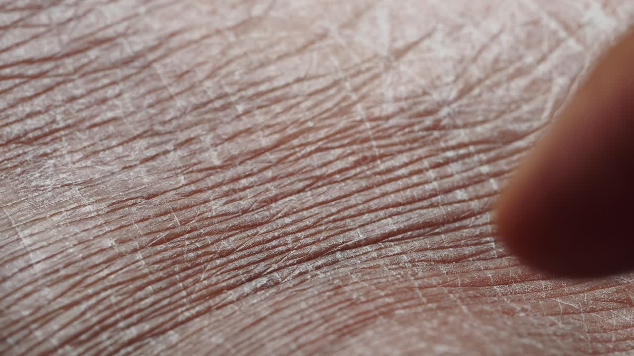 piel seca y agrietada en la mano