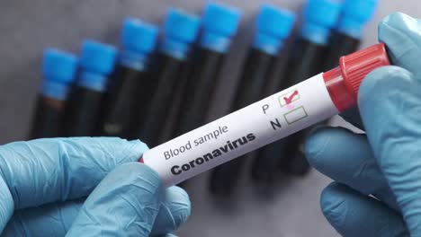 coronavirus blood sample test