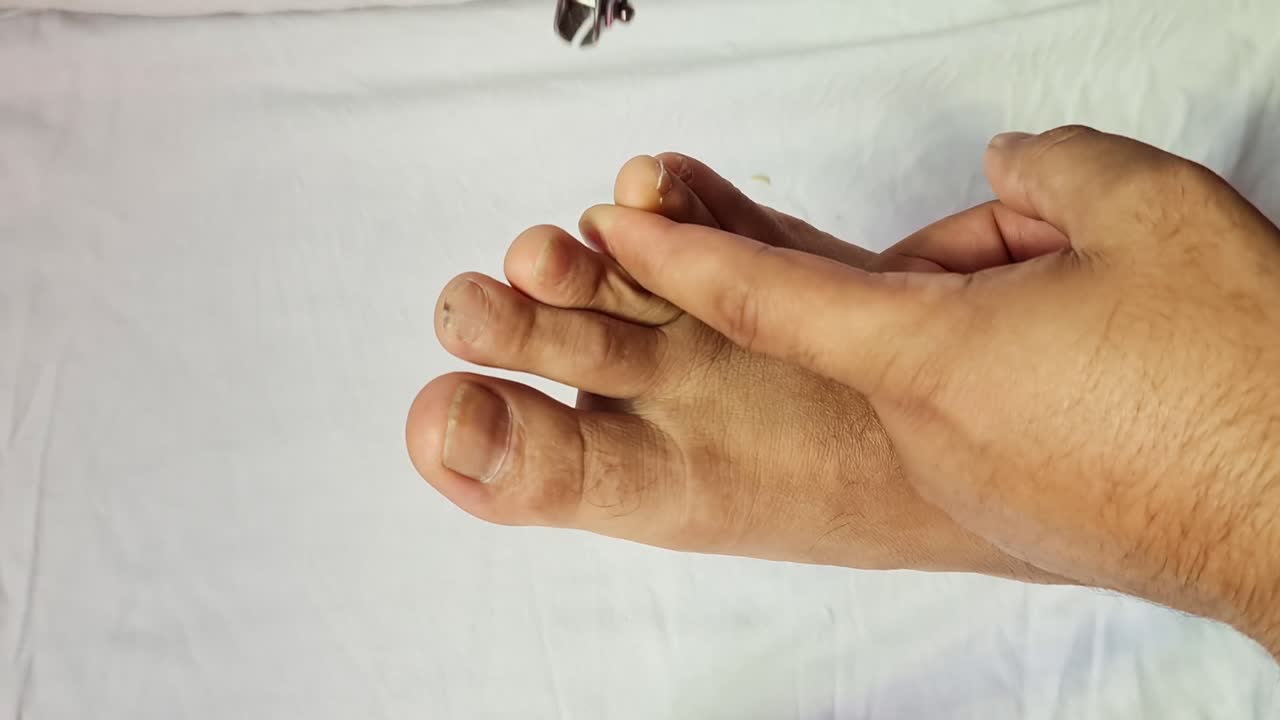 Nail cutting foot with damaged nails because of fungus