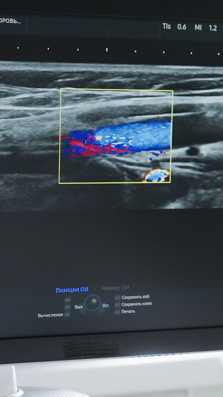 color Doppler ultrasound showing vascular blood flow in superficial vessel, realtime color mapping highlights red and blue flow within lumen while probe sweeps across muscle and tissue, measurement