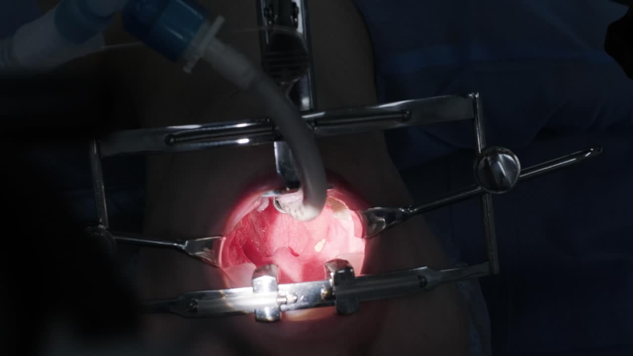 심한 마취 하에서 질을 제거하는 수술, 목구을 가게, 외과 의사는 최신 장비를 사용합니다, 차가운 플라즈마 방법, 목에 부풀이를 잘라, 의사는 새로운 탐지기를 사용합니다.