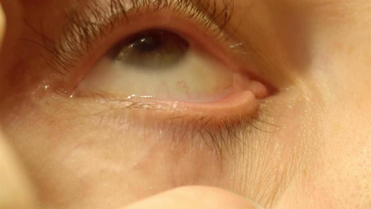 Close up of eye drop application on contact lens
