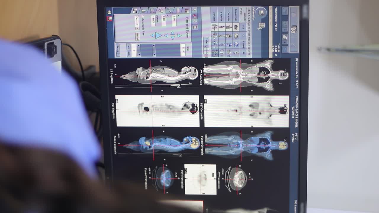 Monitor showing health information of a patient from a clinic, which was scanned with a machine known as PET-CT, which scans patients with tumors in different parts of the body