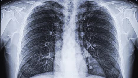 a detailed examination reveals the structure of the lungs with potential irregularities noted in a chest x-ray taken for a routine health check. the image shows clear bronchial patterns.