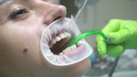 Young-woman-with-and-expander-in-mouth-at-the-dental-clinic.-Cleaning-teeth-with-water.-Modern-dental-office.-Dentist-using