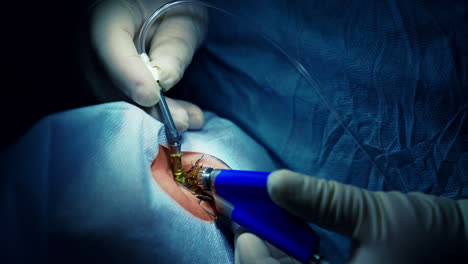 surgeon performing eye operation. ophthalmologist operating eye of patient in medical clinic