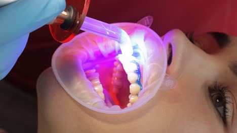 dental procedure - light curing