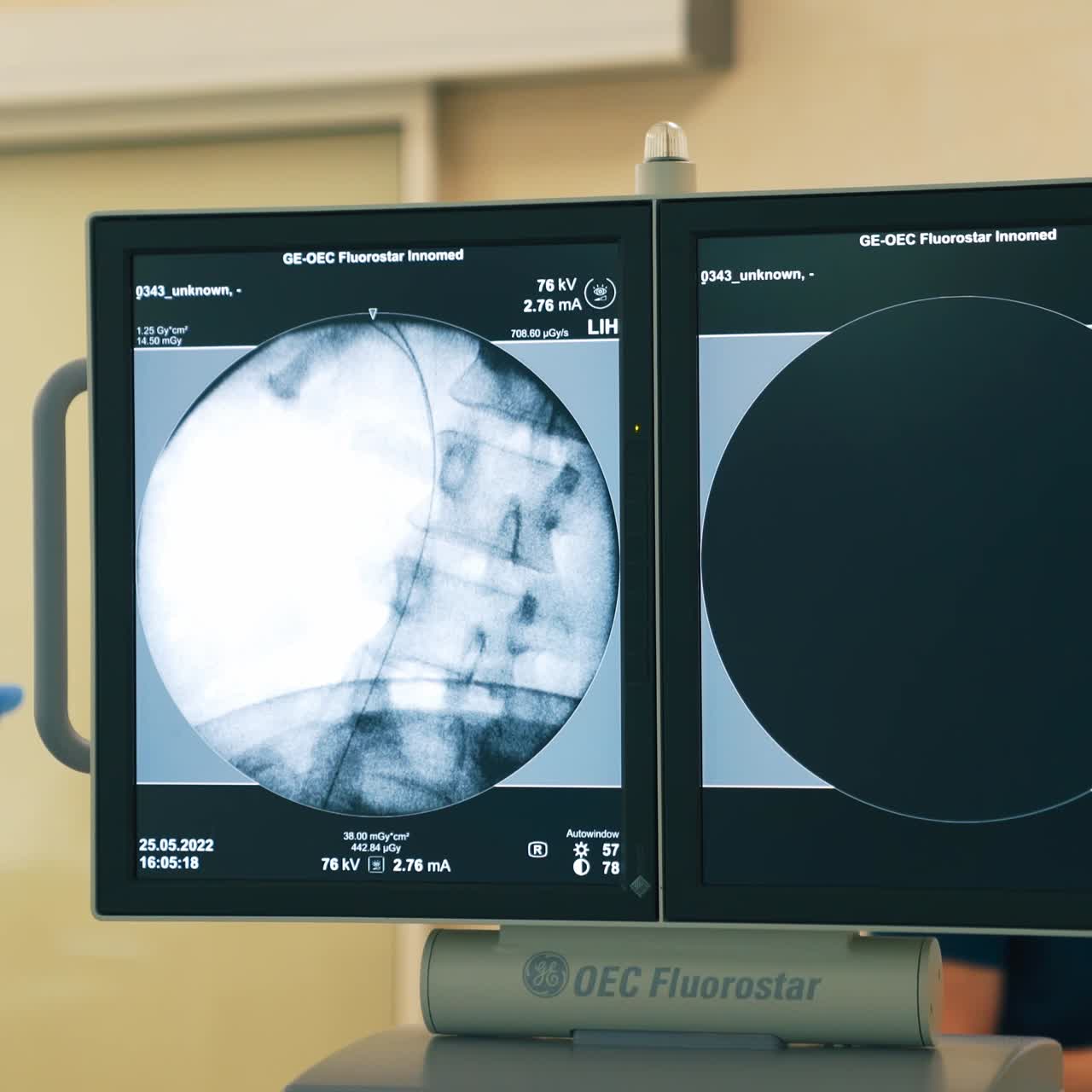Double black screen of a modern equipment working in surgery theatre. Picture showing the x-ray of a spine of a patient