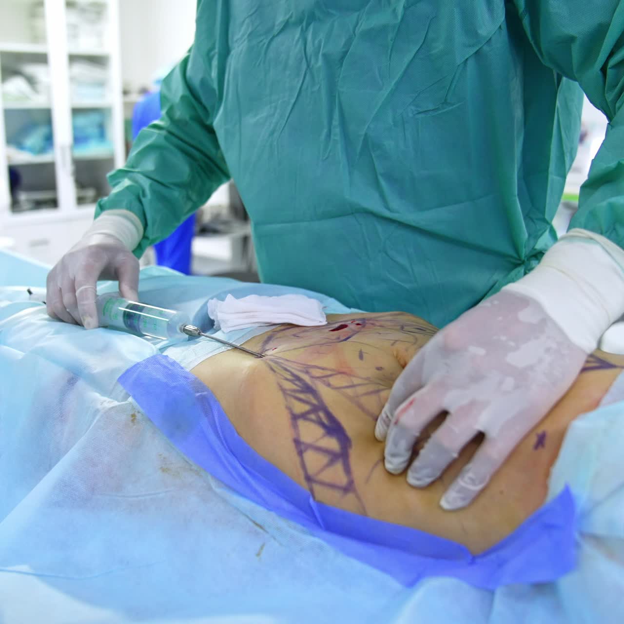 Abdominoplastic surgery in process. Surgeon thrusting the huge syringe into patient's belly