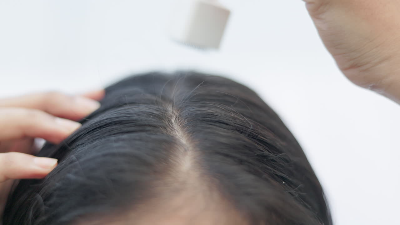 Microneedling treatment, hair loss, collagen induction therapy. Indian young woman using derma stamp on her alopecia head.