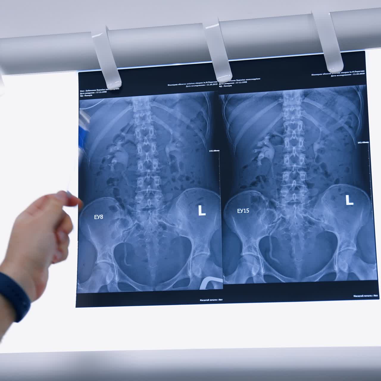 Two x-ray scan of inner organs on the light screen. Doctor's hand pointing at shots with a pen explaining the problem