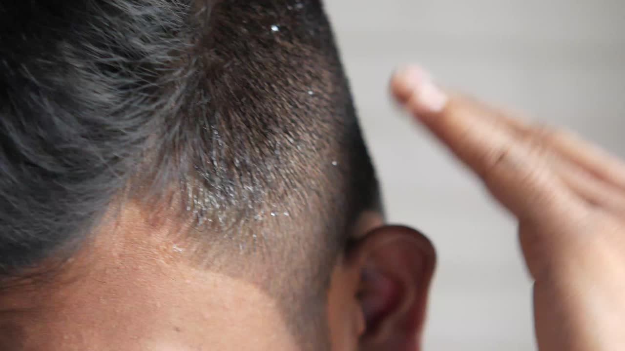Dandruff on scalp