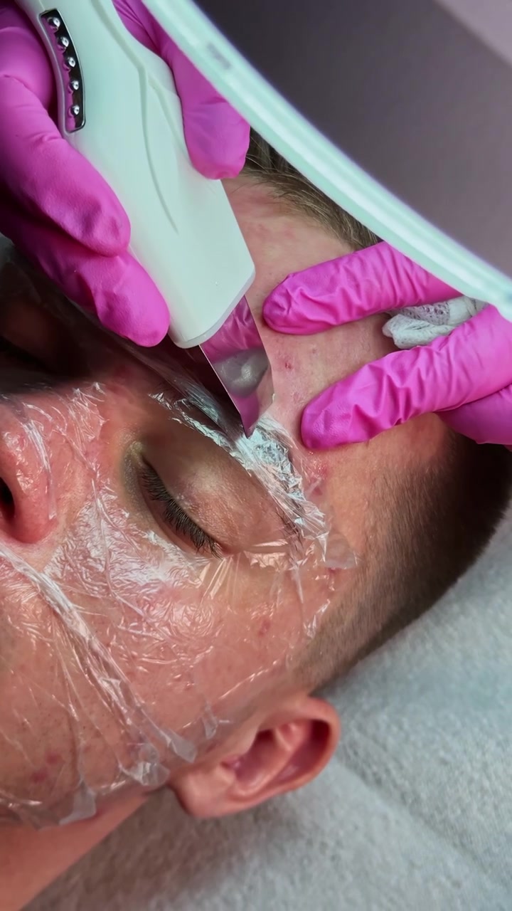 Uomo riceve un trattamento viso con uno strumento per dermaplaning in una clinica estetica di giorno