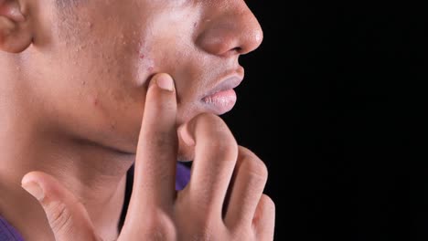 primer plano de la cara de un joven con acné
