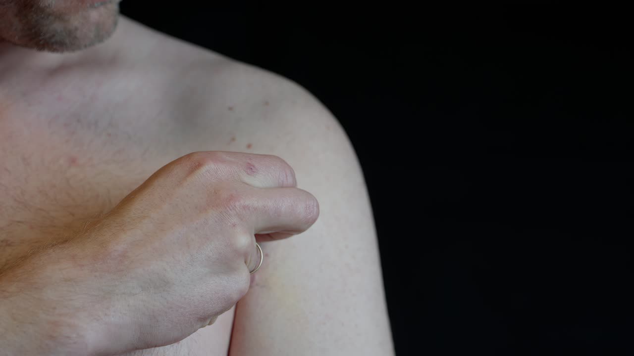 Male removes final tape from healing chest scar after pectoralis tendon surgery. Gently touches and inspects skin. Dark background enhances detail