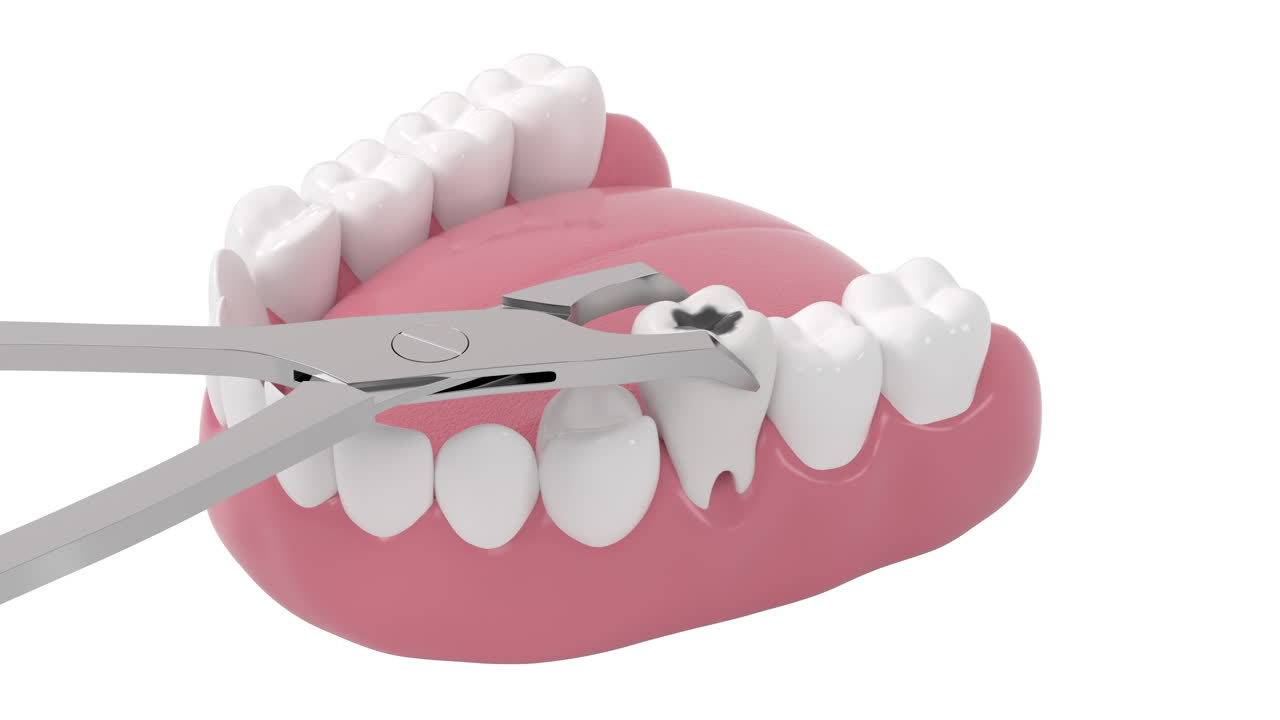 sacar la caries dental, los dientes no saludables, la representación en 3d.