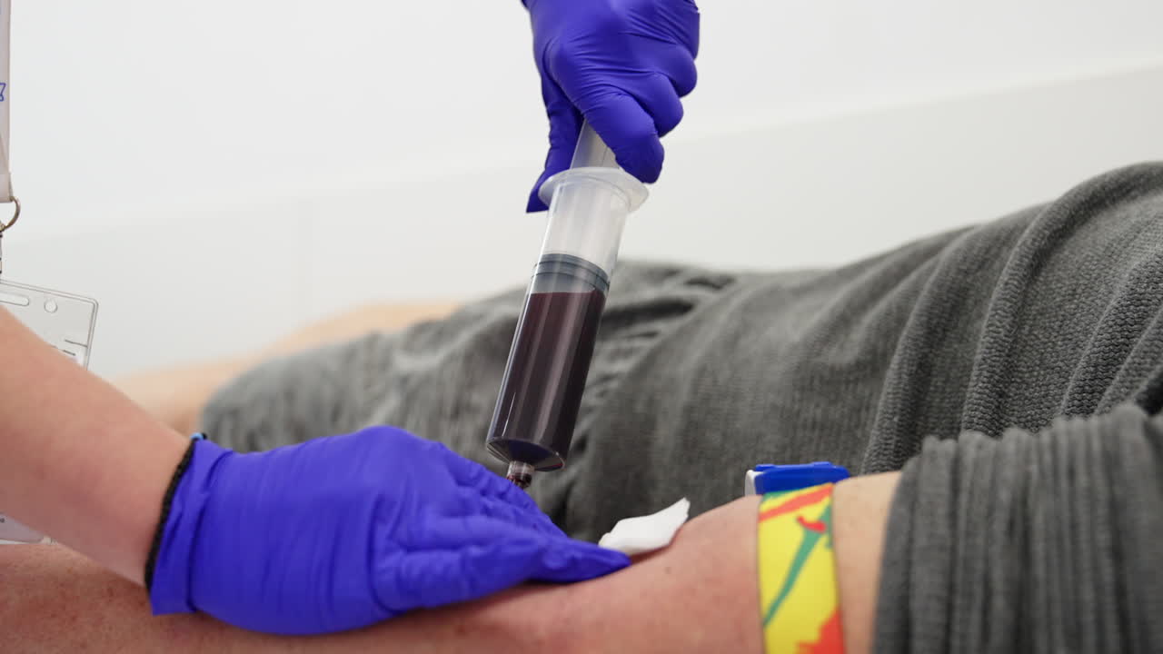Unrecognized medic in blue gloves fills the large syringe with patient's blood. Preparation for prp therapy. Close up.