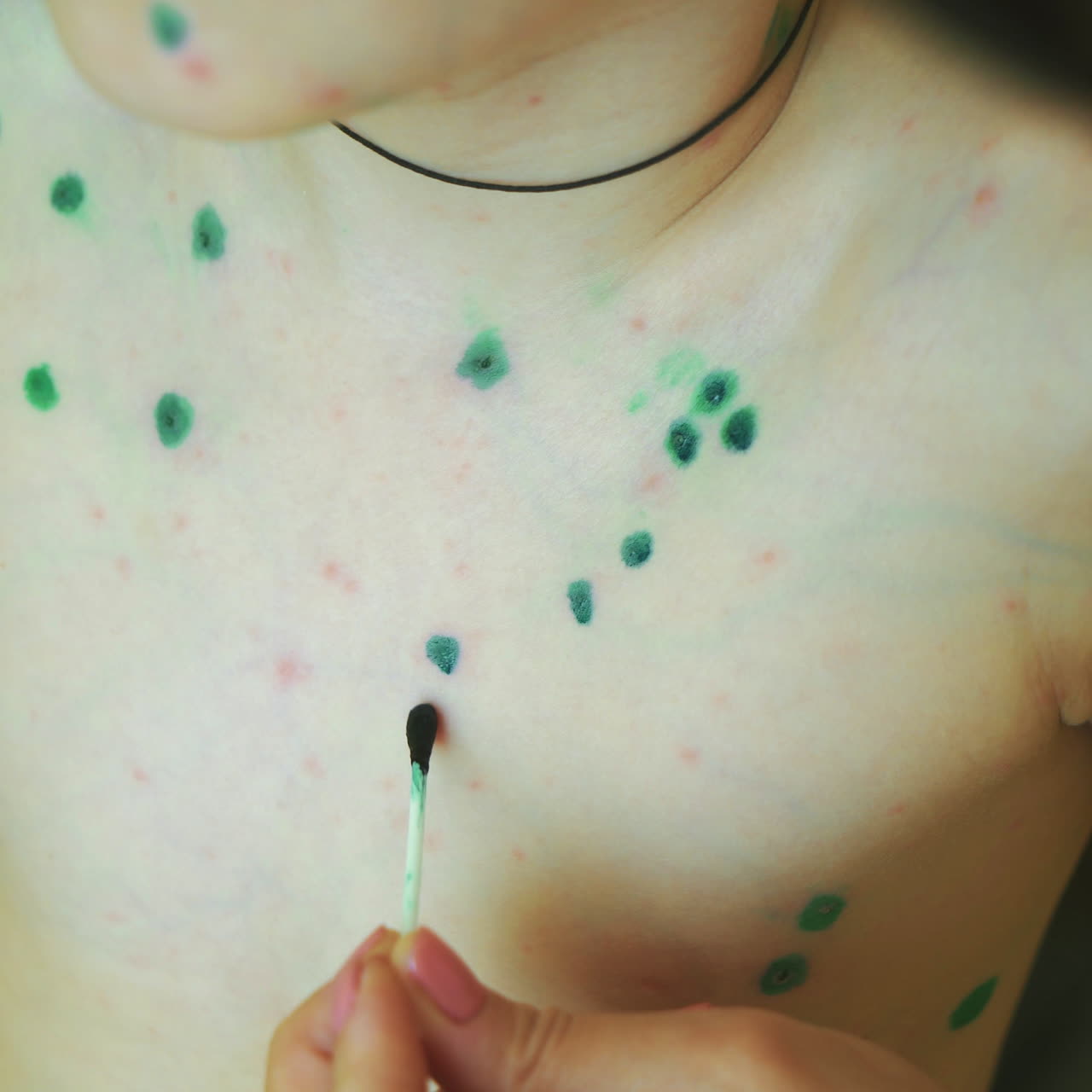 Little boy with chickenpox. Mother applying antiseptic solution to rash. Home treatment. Square video