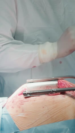 el cirujano utiliza suturas para cerrar el pecho. el médico utiliza suturas absorbibles para cerrar la capa facial asegurando el cierre adecuado después del procedimiento de bypass de la arteria coronaria