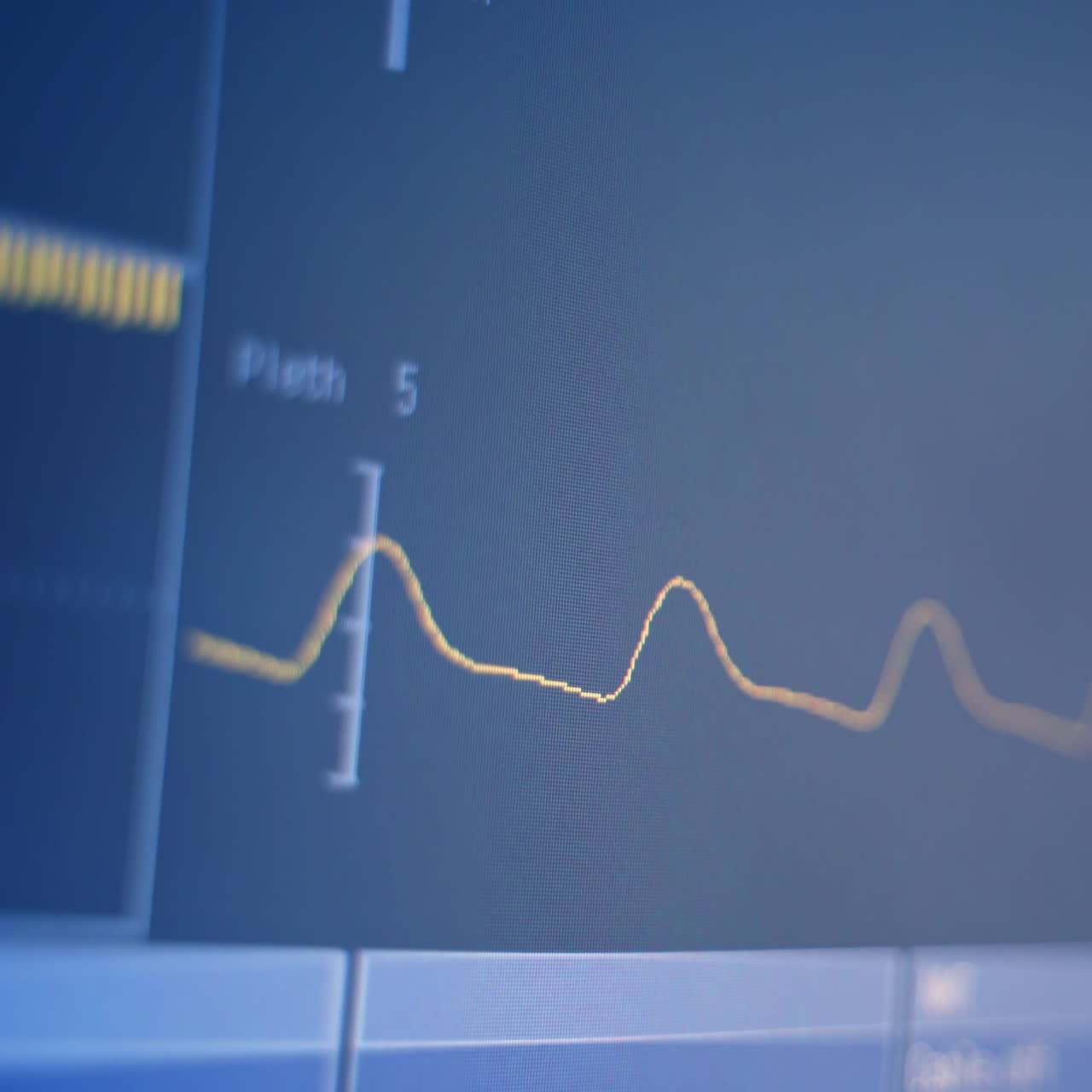 Heartbeat Display Monitor Electrocardiography. Vital signs on ICU monitor in hospital