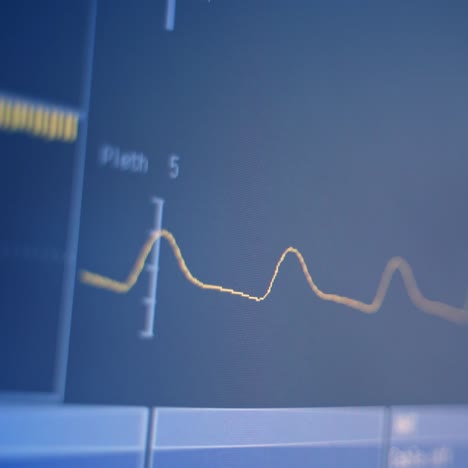 heartbeat display monitor electrocardiography. vital signs on icu monitor in hospital