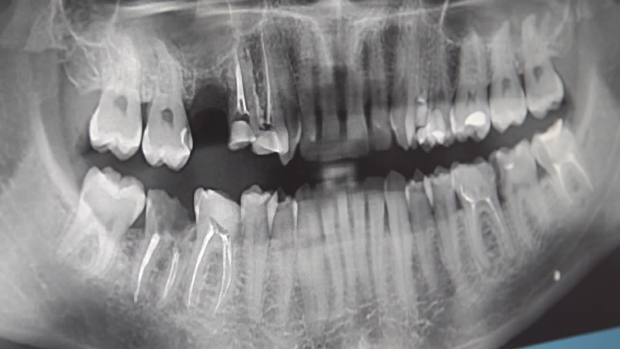 Dental X-ray Panoramic View