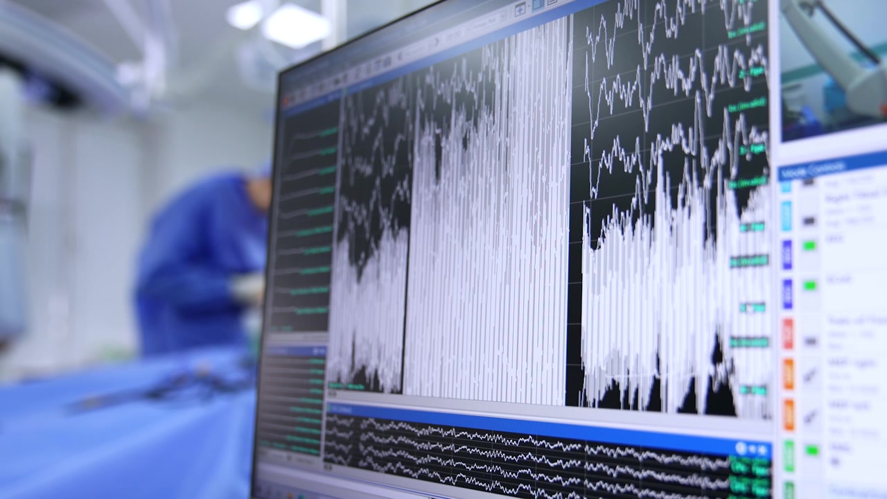 Monitor del computer con grafici in esecuzione. Attrezzatura medica che lavora durante l'intervento chirurgico. Primo piano.