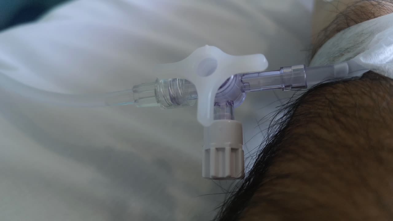 환자에게 부착된 상태에서 염화나트륨 값과 튜브의 클로즈업