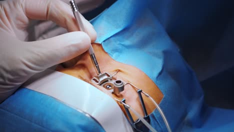 laser vision correction. a patient and team of surgeons in the operating room during ophthalmic surgery. eyelid speculum. lasik treatment. patient under sterile cover