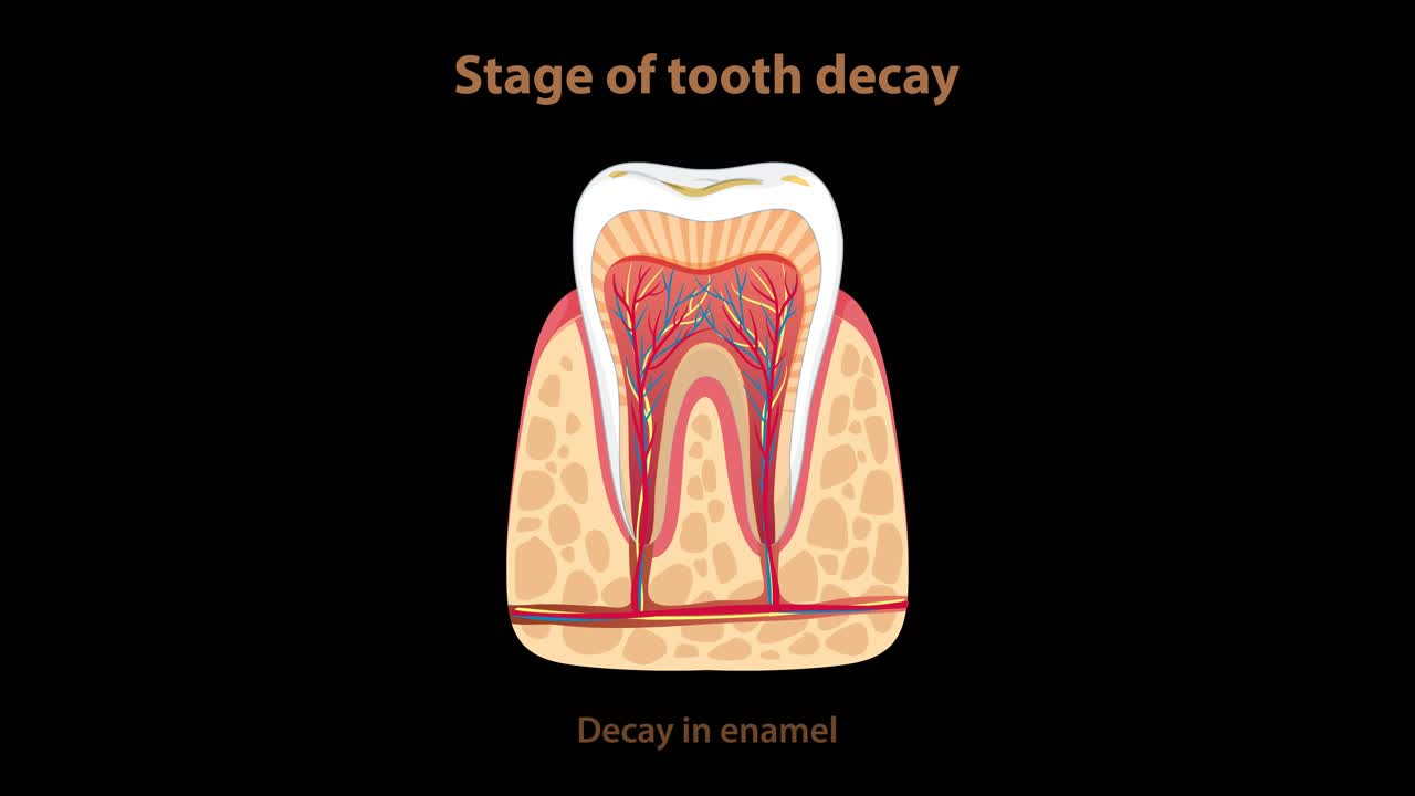 Detailed animation visually explains the step-by-step progression of tooth decay, highlighting anatomical changes from healthy tooth to advanced pulp involvement using clear cross-sectional diagrams on a black background