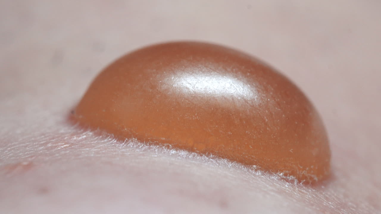 крупный план инфицированного кожного волдыря, наполненного гноем и жидкостью, пациент получает медицинскую помощь в больнице