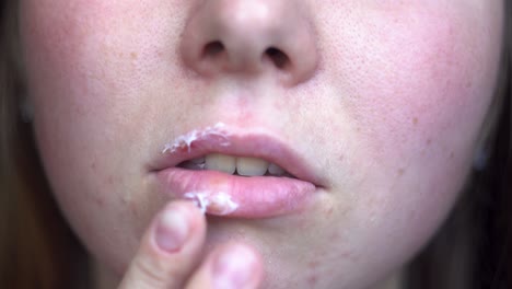 woman applying lip balm to a sore lip