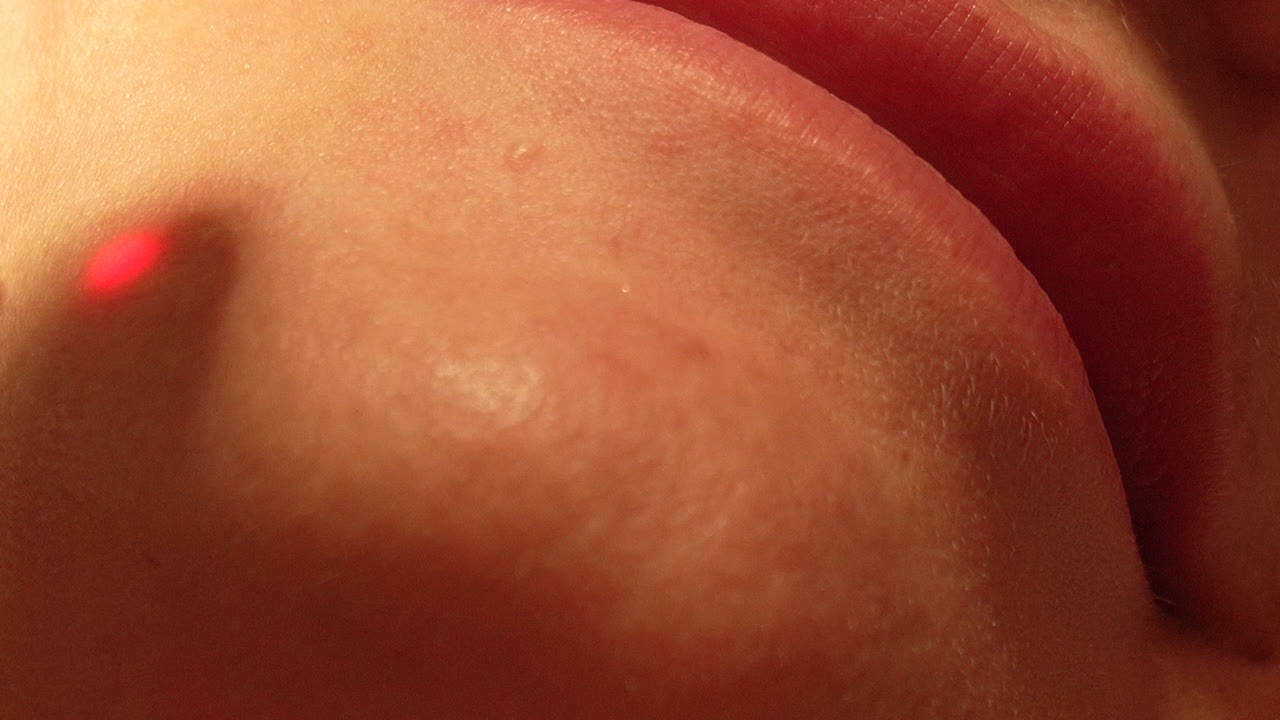 피부 치료의 고도로 확대된 시각, 피부 표면과의 도구의 상호 작용에 초점을 맞추고, 피부 절차의 복잡성을 설명합니다.