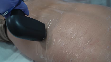 laser hair removal in action on treated skin - close up