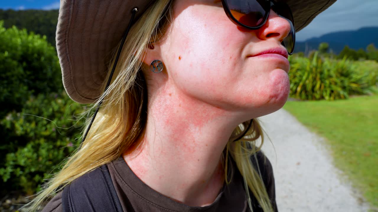 Female explorer suffering from dermatitis irritation on neck skin