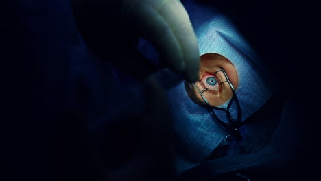 eye surgery. eye-specialist operating patient's eye. operation on eye in operating room. surgical procedure to improve vision. close-up.